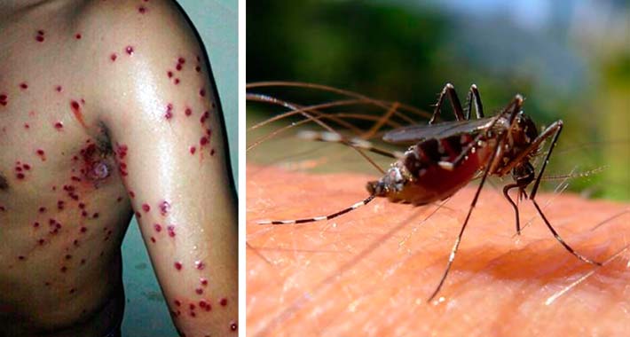 Cómo evitar la Chikungunya en 5 pasos